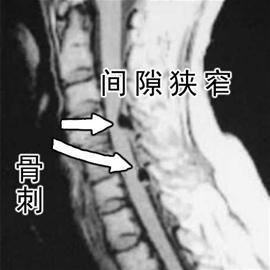 骨刺的症状的表现有哪些.jpg