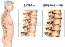 树立战胜疾病的信心，强直性脊柱炎并非不治之症!.jpg