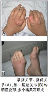 痛风的临床症状表现.jpg