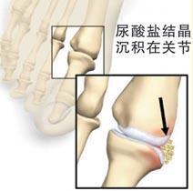 如何自我判断是不是得了痛风.jpg