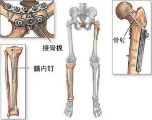 治疗骨折，不能打“折扣”.jpg